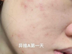 吃了异维a全身痒怎么办—吃了异维 A 全身痒，该怎么办？