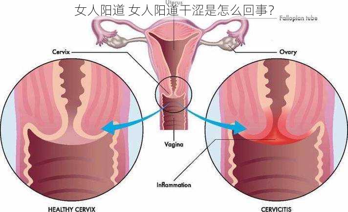 女人阳道 女人阳道干涩是怎么回事？