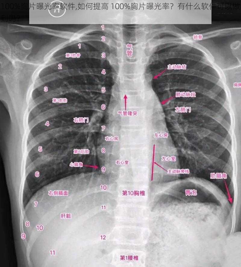 100%胸片曝光率软件,如何提高 100%胸片曝光率？有什么软件可以做到吗？